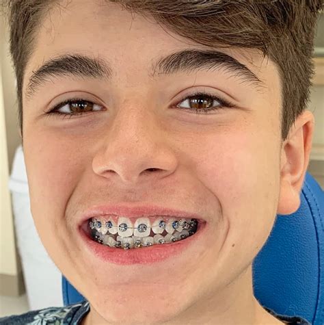 Color Braces: See Why Kids Love Their Fun Colorful Smiles