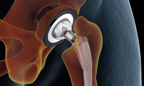 What Does The Total Hip Replacement Recovery Process Look Like ...