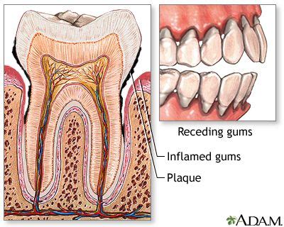Gingivitis: MedlinePlus Medical Encyclopedia Image | Gum disease treatment, Gum disease, Gingivitis