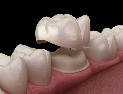 Types Of Crowns For Teeth