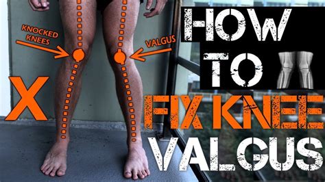 How to Fix Knee Valgus - Functional Leg Training | Knee exercises, Leg training, Knock knees