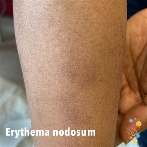Erythema nodosum - Skin Deep