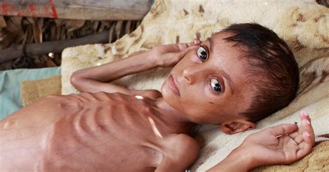 Starving, malnourished children at risk in Yemen