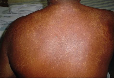 Widespread induration of the skin - Indian Journal of Dermatology, Venereology and Leprology