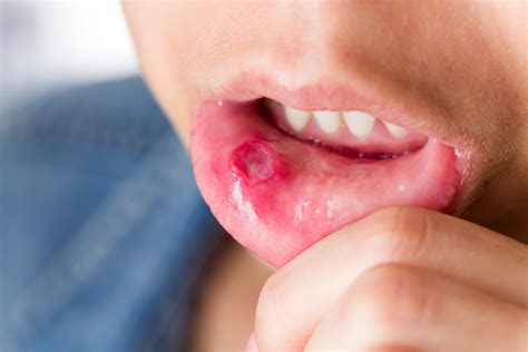 Mouth Ulcers Treatment London - Smile Clinic London