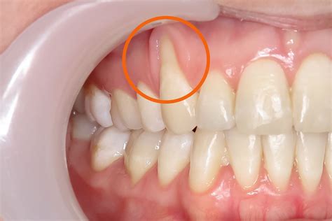 Understanding Gum Recession: Causes, Symptoms, and Treatment