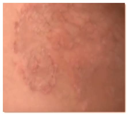 Intertrigo - Rash Pictures, Symptoms, Causes, treatment