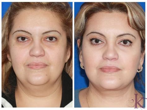 Facelift Dr. Vasyukevich Facial Plastic Surgeon NYC 51