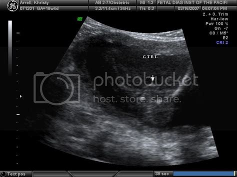 ULTRASOUND AT 19 WEEKS....A GIRL - BabyGaga