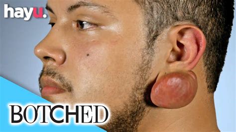 Man Suffers With Keloid Scars After Piercing Ears! | Botched - YouTube