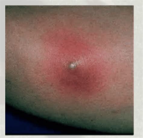 How To Identify Spider Bites And Treat Them - vrogue.co