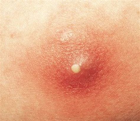 Infected Pimple - Pictures, Symptoms, Causes, Treatment