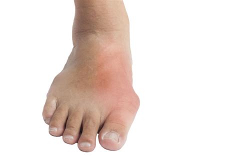 Can Gout Cause Ankle Swelling