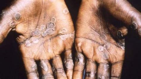 Monkeypox in US: CDC monitoring 200 people in 27 states, other ...