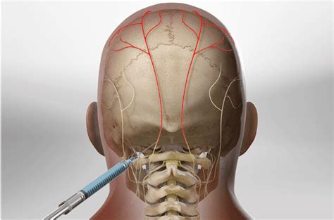 Lesser Occipital Nerve Blocks Coding