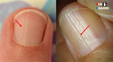 Do You Have These Vertical Ridges On Your Nails?