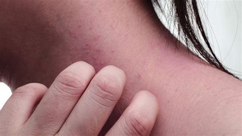 Eczema Causes: What to Do If You Have Dry, Itchy Skin