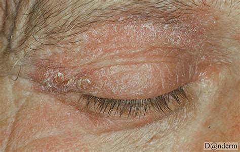 3-235 Psoriasis. Koebner phenomenon of the eyelids from Rockwool dust (2 of 2)