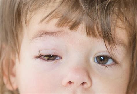 Conjunctivitis In Infants & Children: Causes, Symptoms & Treatment