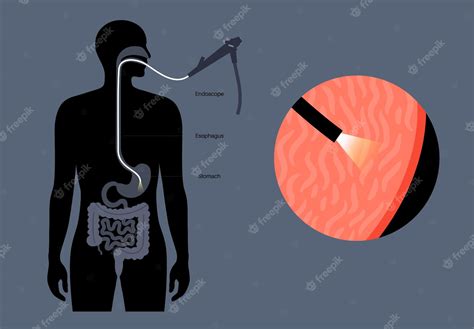 Premium Vector | Gastroscopy procedure Gastroenterologist uses a ...