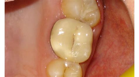 Dental Crown Failure- Causes and Management