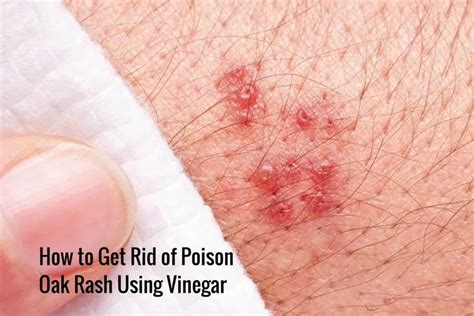 How To Get Rid Of Poison Ivy Rash Instantly