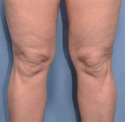 Fat Knees. Causes And Cures. — Sensible Fitness Personal Training