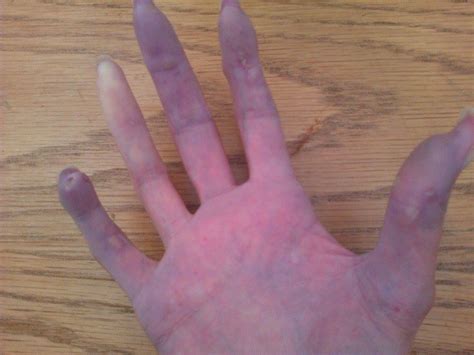 Scleroderma and Handling Raynaud's, Digital Ulcers