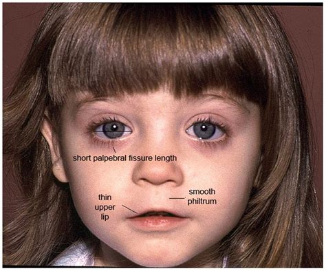 Maksud Fetal Alcohol Syndrome