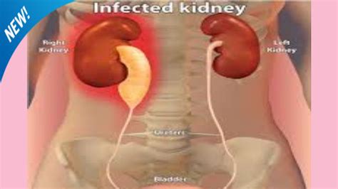 [latest *] symptoms of kidney infection (UTI infection) ~ Health Physician