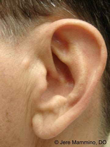 Accessory Tragus - American Osteopathic College of Dermatology (AOCD)