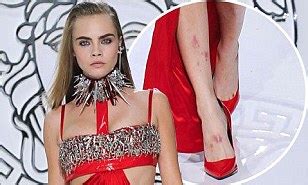 Cara Delevingne suffers stress-induced psoriasis which causes her legs ...