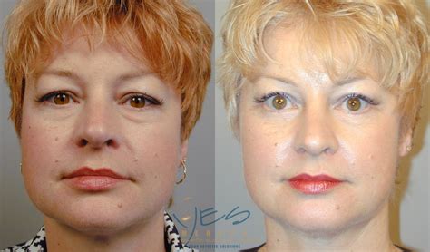 Eyelid Surgery Blepharoplasty Before And After Pictur - vrogue.co