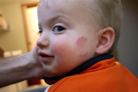 Love bite | Z shows off the badass bite marks on his cheek f… | Flickr