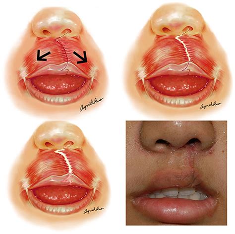 Contractions of the orbicularis oris muscle are believed to inflict ...