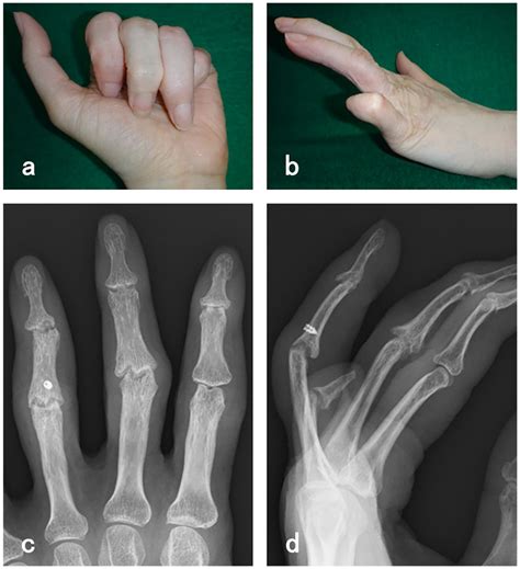 Degloving Injuries: An In-depth Understanding The Disability Doc