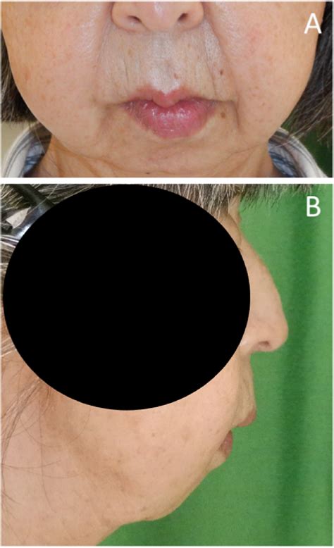 Facial photographs. (A, B) Micrognathia is seen. | Download Scientific ...