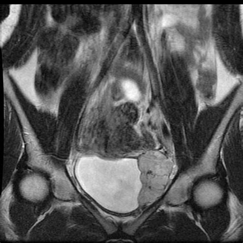 Pheochromocytoma MRI - wikidoc