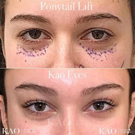 cat eye surgery | pony tail lift | plastic surgery | cirugía cosmética ...