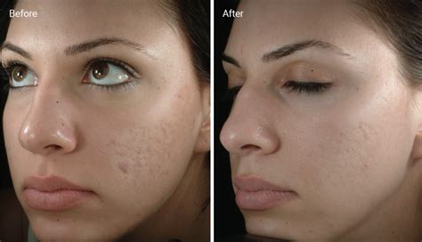 Microdermabrasion for Acne Scars: How It Works, Benefits, Efficacy & Cost