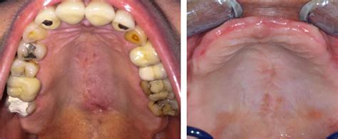 Palatal torus: etiology, clinical aspect, and therapeutic strategy | Journal of Oral Medicine ...