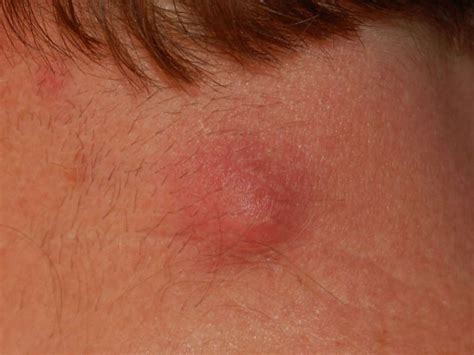 Large Lump On Neck | Images and Photos finder