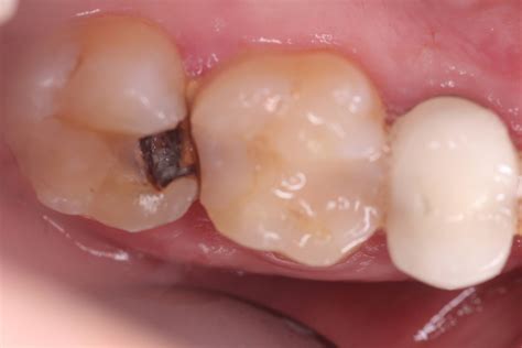 How to Prevent Root Canals With Ozone - Integrative Dentistry, San ...