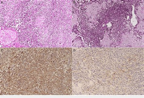 Carcinosarcoma (sarcomatoid carcinoma) showing both malignant ...