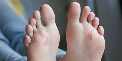 Blisters | Benenati Foot and Ankle Care Centers