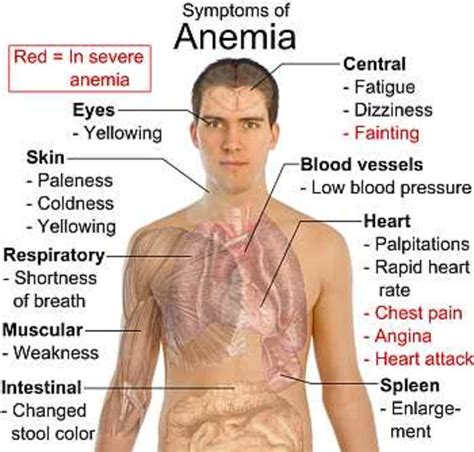 What Is Anemia : Causes, Symptoms, Foods to Cure Iron Deficiency | HubPages