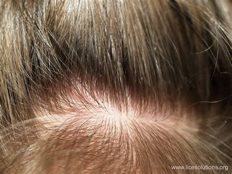 Head Lice - Nits on Hair | For more information on treating … | Flickr