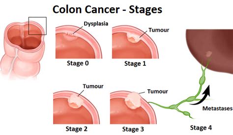 Stage 4 Colon Cancer - CancerWalls