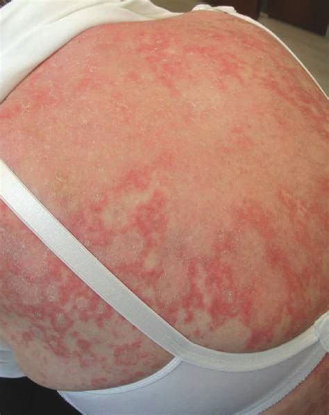 Rheumatoid Arthritis Rash Treatment