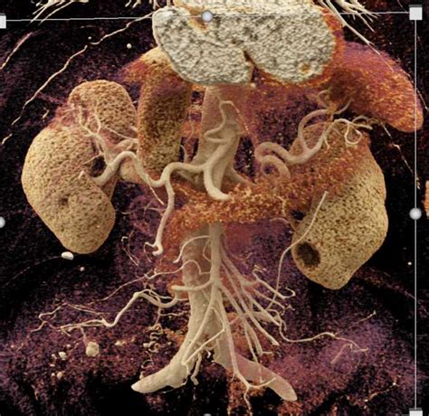 Transitional Cell Carcinoma - Kidney Case Studies - CTisus CT Scanning